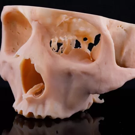 Impression 3d Secteur Sante